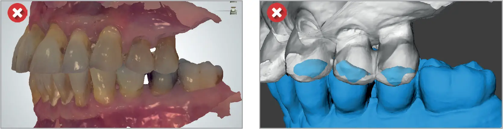 Incorrect scans linked to occlusion 02