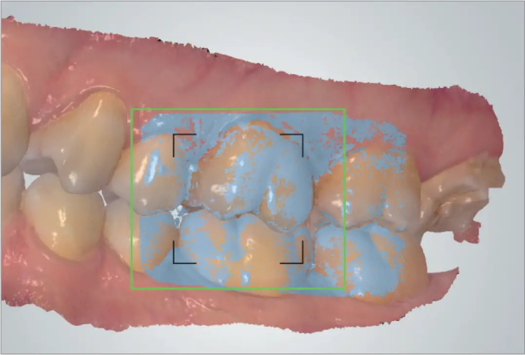 Scan in Centric Occlusion and Measurements