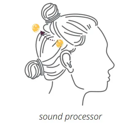 Cochlear D1938445-V3 MRI Kit - Figure 2