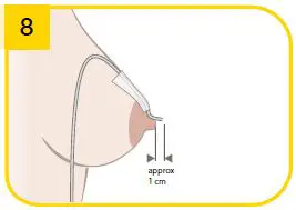 medela-SNS 009.0005-Supplemental-Nursing System-15