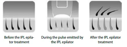 concept- IL3000 -Perfect- Skin- IPL -Epilator - fig 2