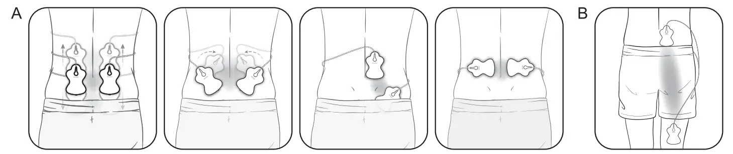 OMRON HV-F02 Electronic Nerve Stimulator - Fig 12