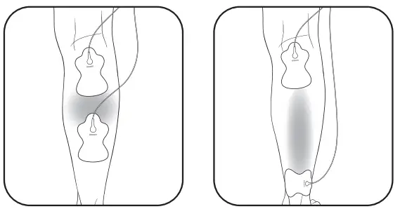 OMRON HV-F02 Electronic Nerve Stimulator - Fig 17