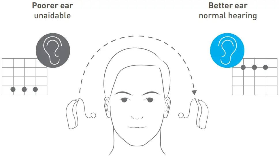 Contralateral Routing of Signal