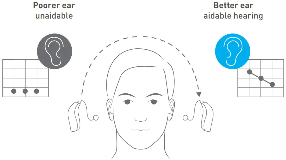 Contralateral Routing of Signal