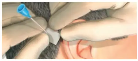 oticon MIPS Minimally Invasive Ponto Surgery - Choose abutment length 2