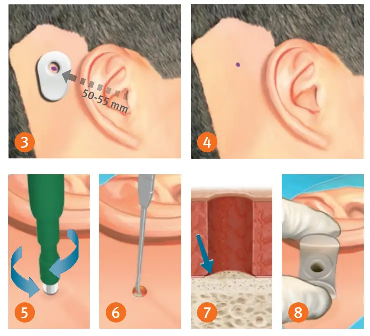 oticon MIPS Minimally Invasive Ponto Surgery - STEP 1