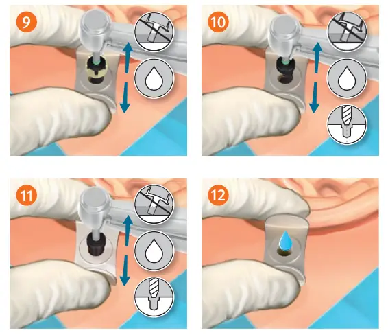 oticon MIPS Minimally Invasive Ponto Surgery - STEP 3