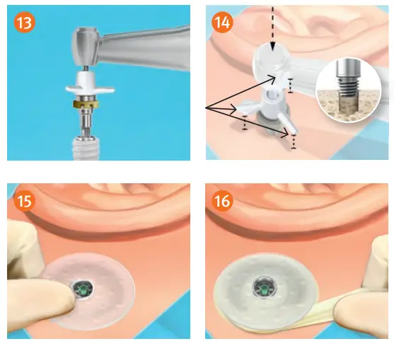oticon MIPS Minimally Invasive Ponto Surgery - STEP 4