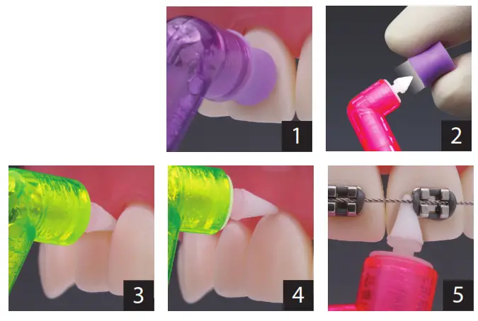 premier 2pro Total Access Disposable Prophy Angle - 1