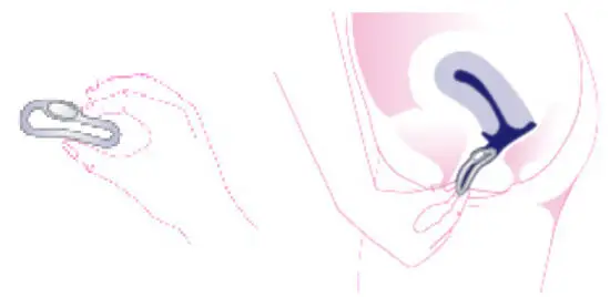 OvulaRing Apps - Inserting OvulaRing