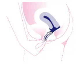 OvulaRing Apps - OvulaRing 1