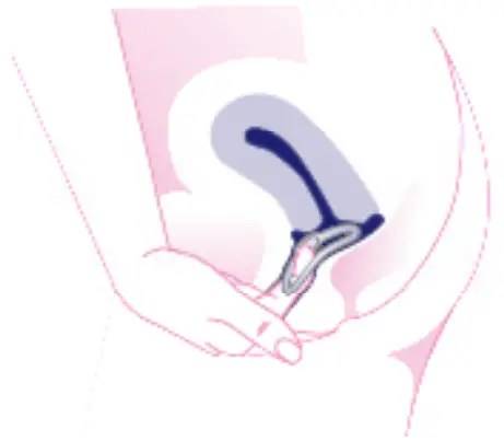 OvulaRing Apps - Removing