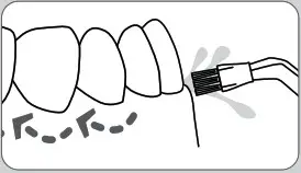 Plaque Seeker™ Tip