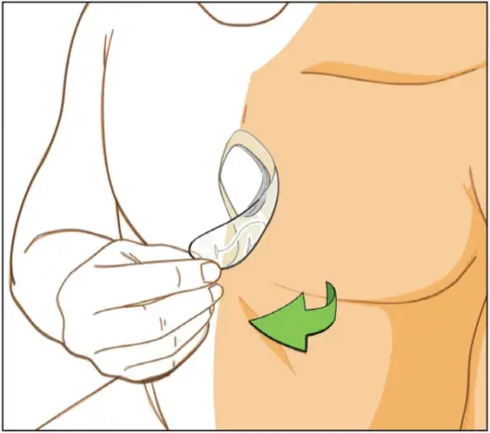 ePatch PBT - Removing the Patch 1