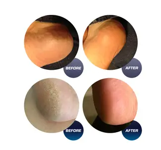 Own Harmo-y-CR1700-Electric-Foot-Callus-Remover-Fig-4