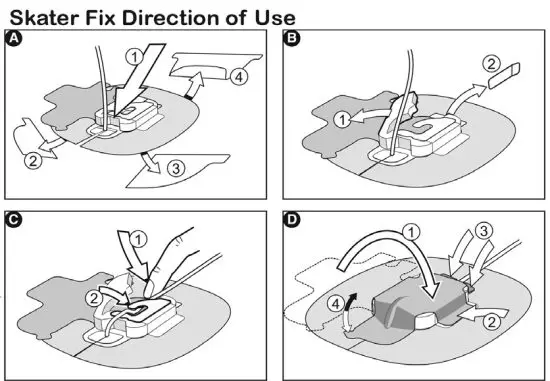 ARGON Skater FIX Catheter Fixation Device - 1