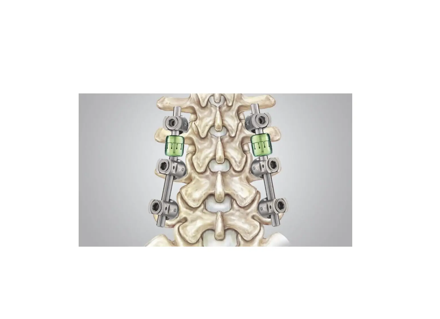 Orthofix Tdx Posterior Dynamic Stabilization System Instruction Manual