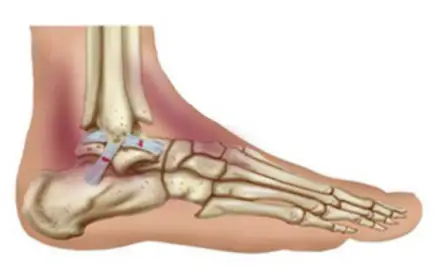 COMMON ANKLE INJURIES