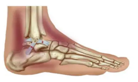 COMMON ANKLE INJURIES
