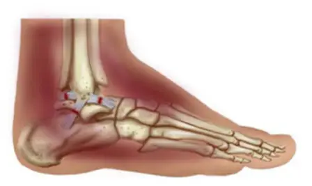 COMMON ANKLE INJURIES
