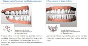 FIG 6 Measurements in maximum protrusion