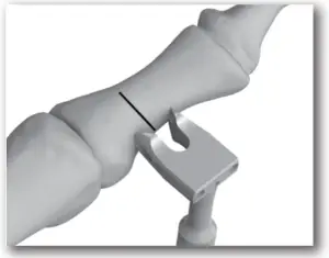 DJO TRILLIANT - SURGICAL TECHNIQUE - STEP 1