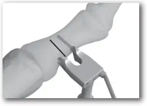 DJO TRILLIANT - SURGICAL TECHNIQUE - STEP 3