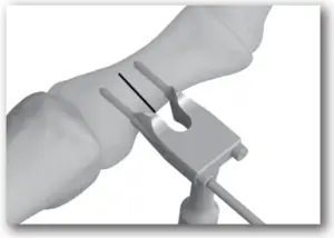 DJO TRILLIANT - SURGICAL TECHNIQUE - STEP 4