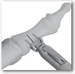 DJO TRILLIANT - SURGICAL TECHNIQUE - STEP 6