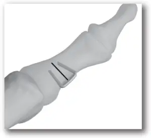 DJO TRILLIANT - SURGICAL TECHNIQUE - STEP 8