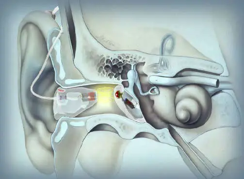 earlens IFU00038vK Contact Hearing Solution Fig1