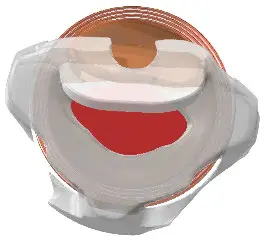 earlens IFU00038vK Contact Hearing Solution Fig7