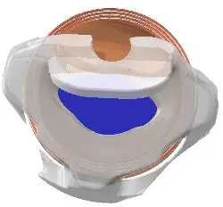 earlens IFU00038vK Contact Hearing Solution Fig8