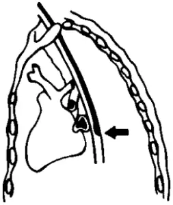 EXACON Temperature Probes - Oesophagus