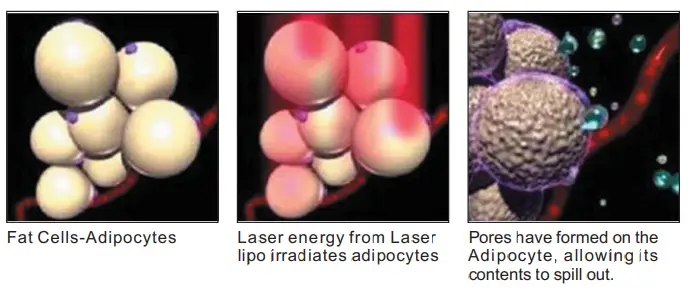 aaoCare-Lipo-Sculpt-Lite-Slimming-Fat-Burner-Machine-1