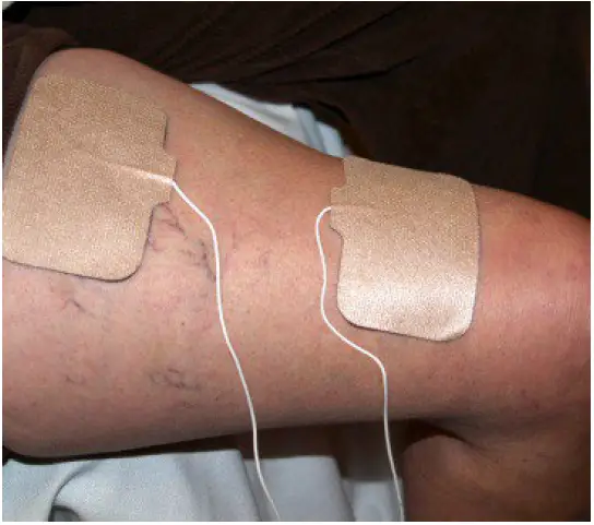 ACP-Omnistim-FX2-Portable-Pens-fig-12