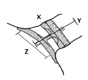 Abbott-Amplatzer-Amulet-Left-Atrial-Appendage-Occluder-11