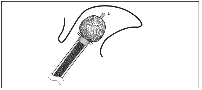 Abbott-Amplatzer-Amulet-Left-Atrial-Appendage-Occluder-4