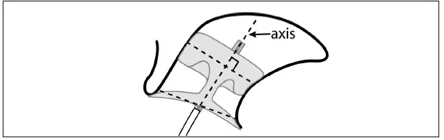 Abbott-Amplatzer-Amulet-Left-Atrial-Appendage-Occluder-5