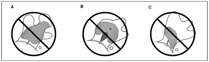 Abbott-Amplatzer-Amulet-Left-Atrial-Appendage-Occluder-7