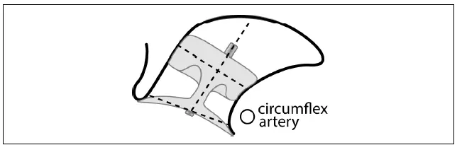 Abbott-Amplatzer-Amulet-Left-Atrial-Appendage-Occluder-8