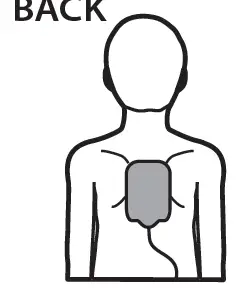 ZOLL-OneStep-Pediatric-Electrodes-fig- (4)