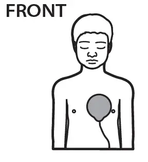 ZOLL-OneStep-Pediatric-Electrodes-fig- (5)