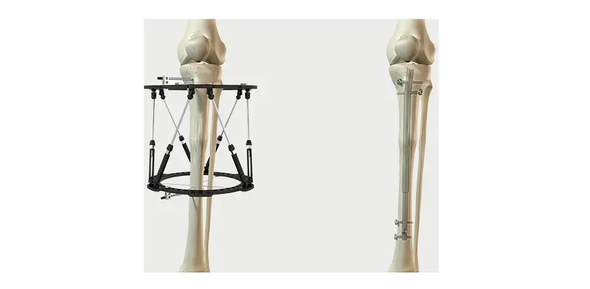 Nuvasive Nso Precice-titanium Ifu Update Final Instructions