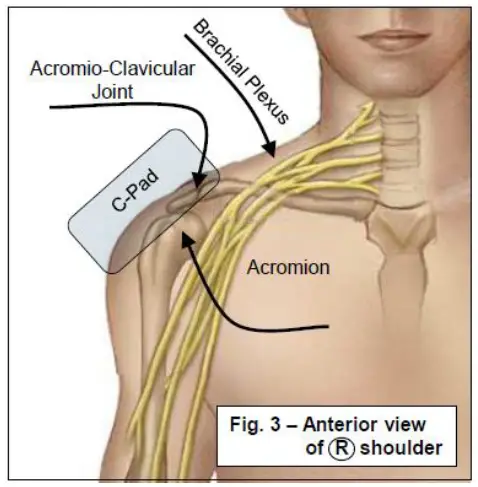 AMATECH F-63500 Shoulder Supports FIG 5