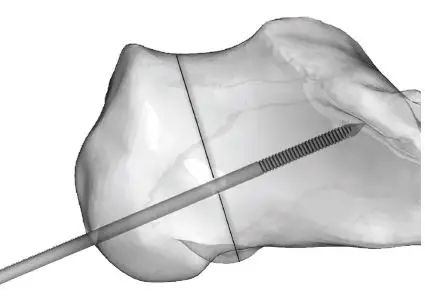 Large Cannulated Screws without Sleeve Assembly 1
