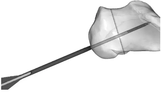 Large Cannulated Screws without Sleeve Assembly 2