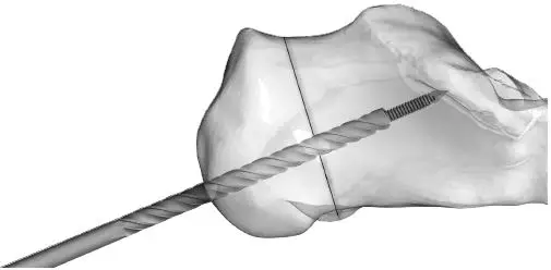 Large Cannulated Screws without Sleeve Assembly 3