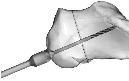 Large Cannulated Screws without Sleeve Assembly 4